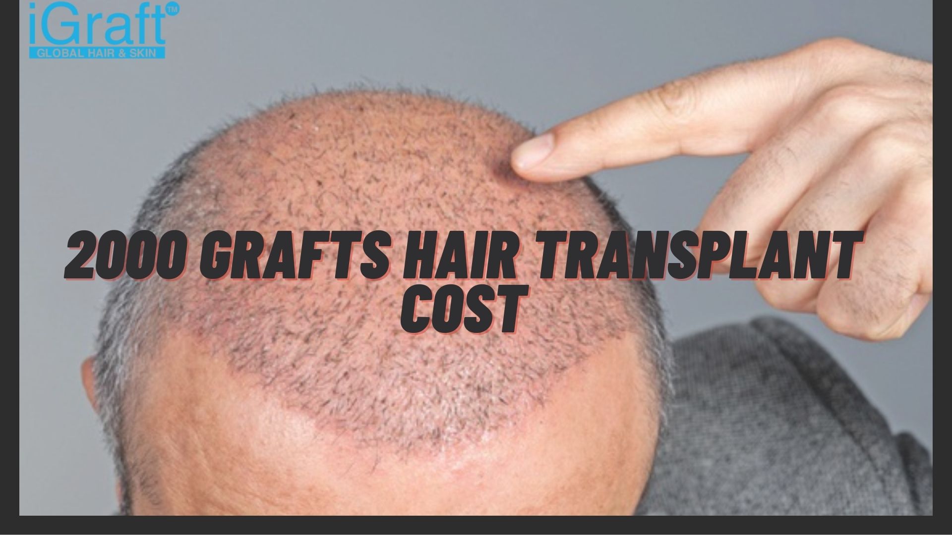 2000 grafts hair transplant cost
