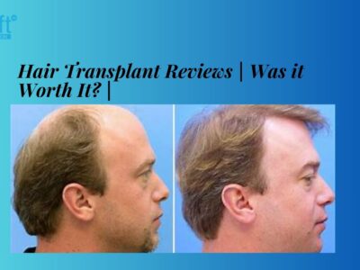 Hair Transplant Reviews