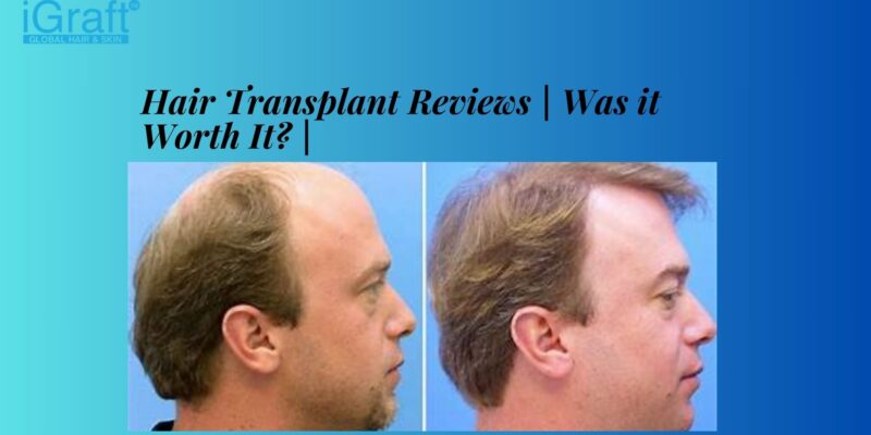 Hair Transplant Reviews