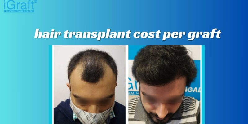 hair transplant cost per graft