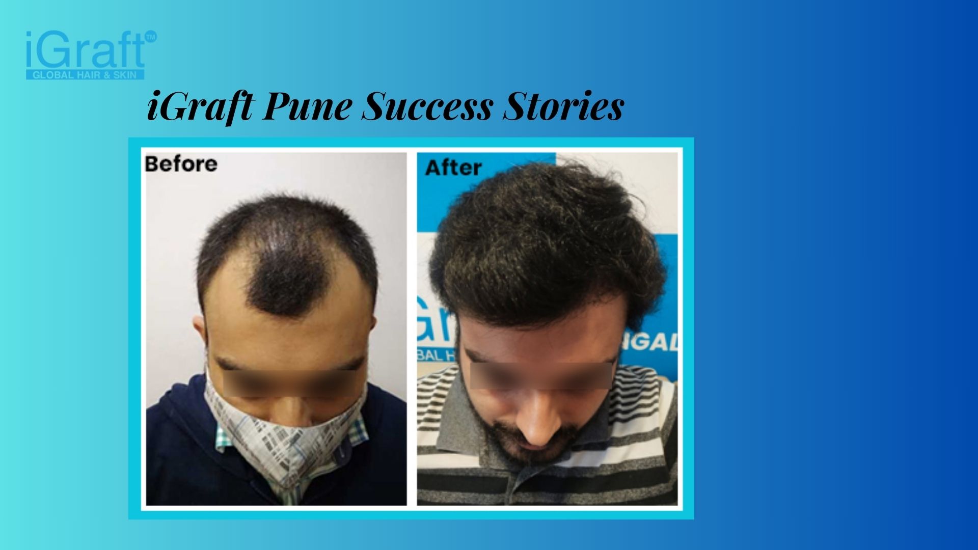 Hair Transplant procedure