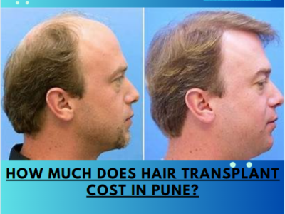 How much does Hair Transplant Cost in Pune?