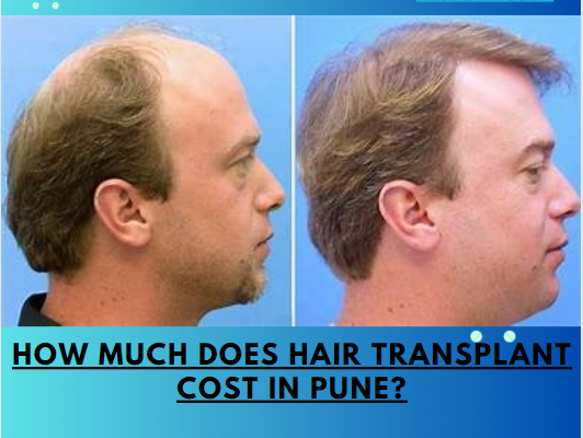 How much does Hair Transplant Cost in Pune?