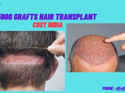 5000 grafts hair transplant cost india