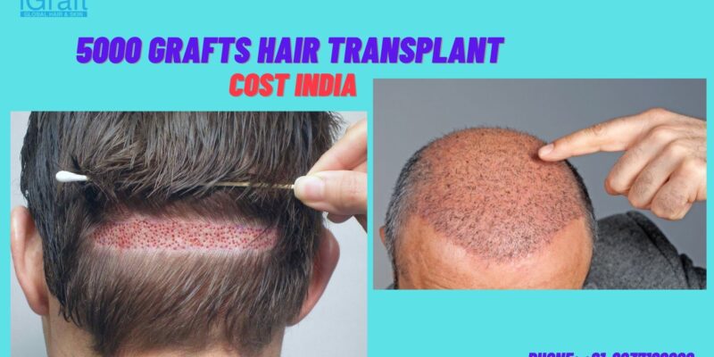 5000 grafts hair transplant cost india