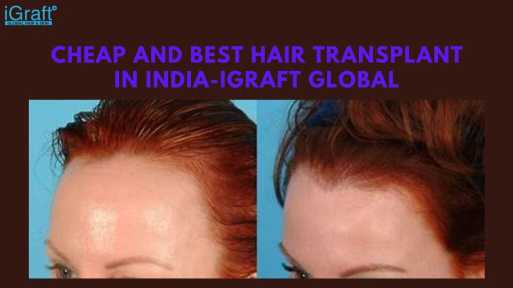 Cheap and Best Hair Transplant in India