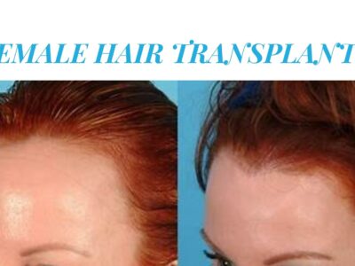 Female Hair Transplant Review