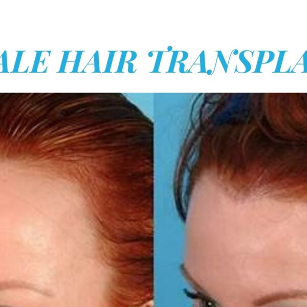 Female Hair Transplant Review