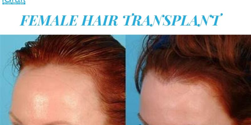 Female Hair Transplant Review