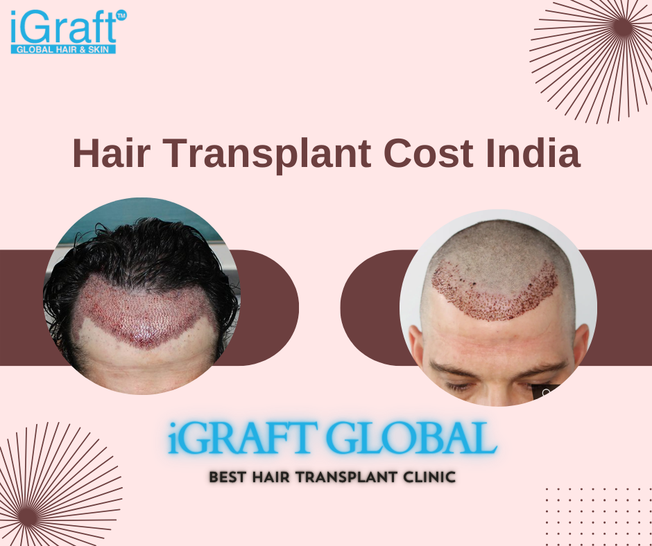 Hair Transplant Cost India