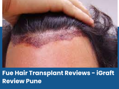 Fue Hair Transplant Reviews