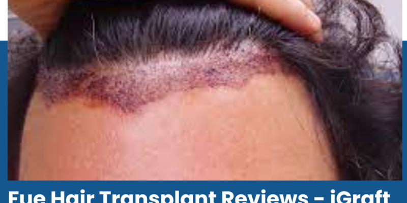 Fue Hair Transplant Reviews