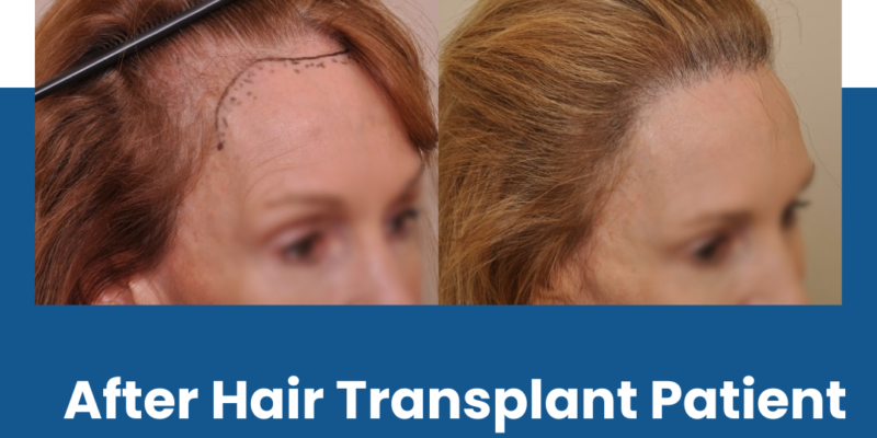 After Hair Transplant Patient Reviews