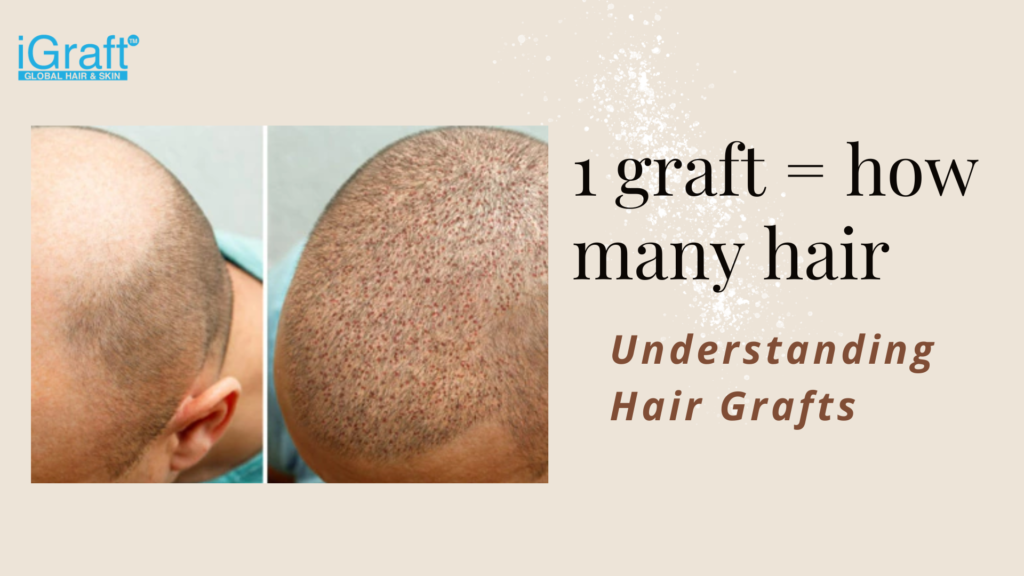 1 graft = how many hair