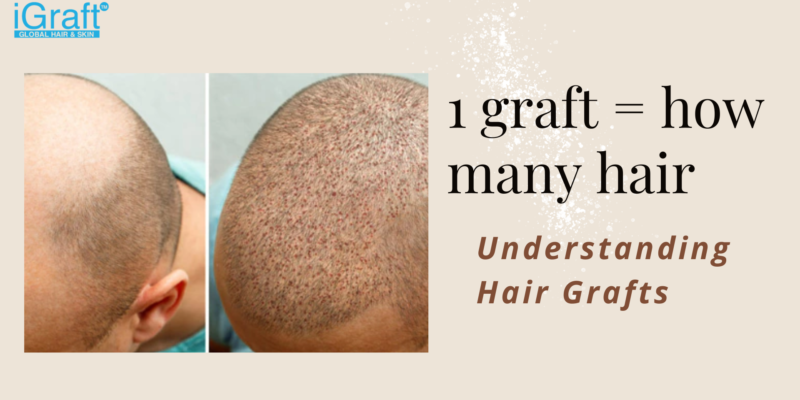 1 graft = how many hair
