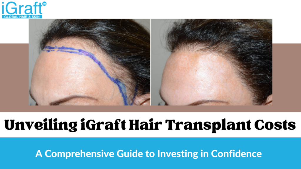 Unveiling iGraft Hair Transplant Costs