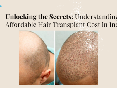 Affordable Hair Transplant Cost in India