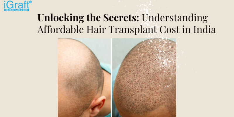 Affordable Hair Transplant Cost in India