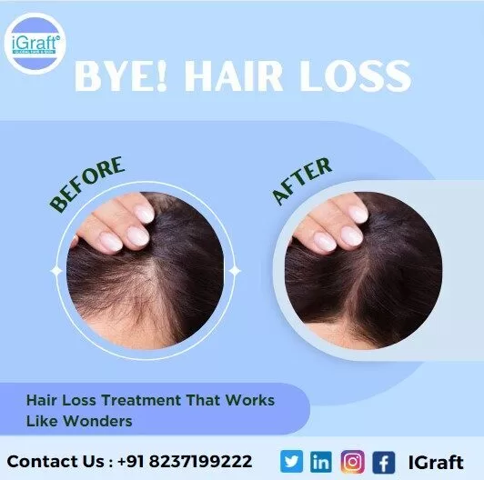 Hair loss treatment