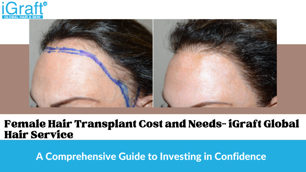 Female Hair Transplant Cost