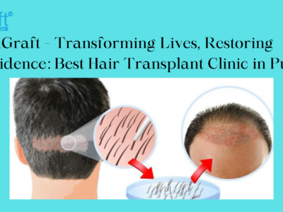 Best Hair Transplant Clinic in Pune