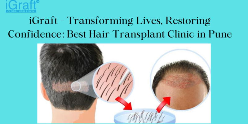 Best Hair Transplant Clinic in Pune