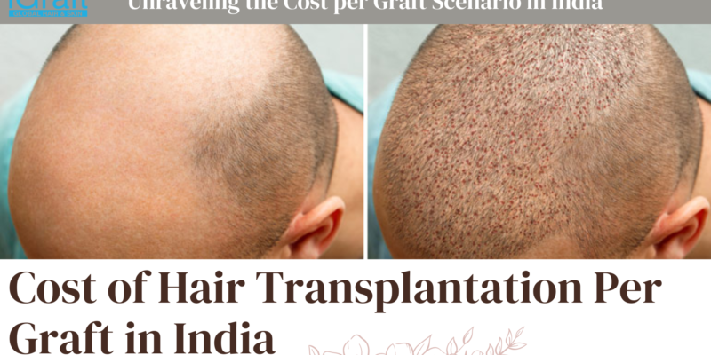 Cost of Hair Transplantation Per Graft in India