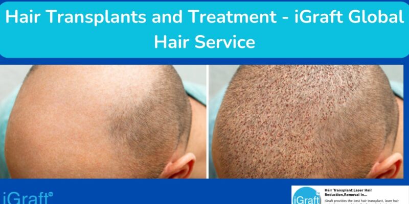 Hair Transplants and Treatment