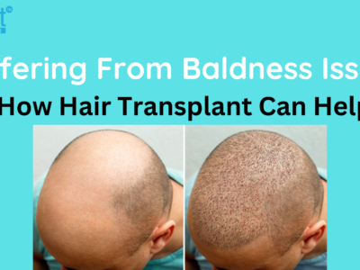 Suffering From Baldness Issue?