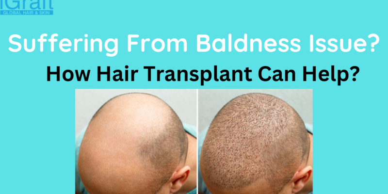 Suffering From Baldness Issue?