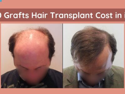 5000 Grafts Hair Transplant Cost in india