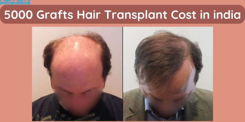 5000 Grafts Hair Transplant Cost in india