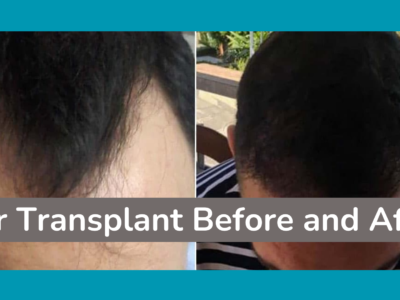 Hair Transplant Before and After