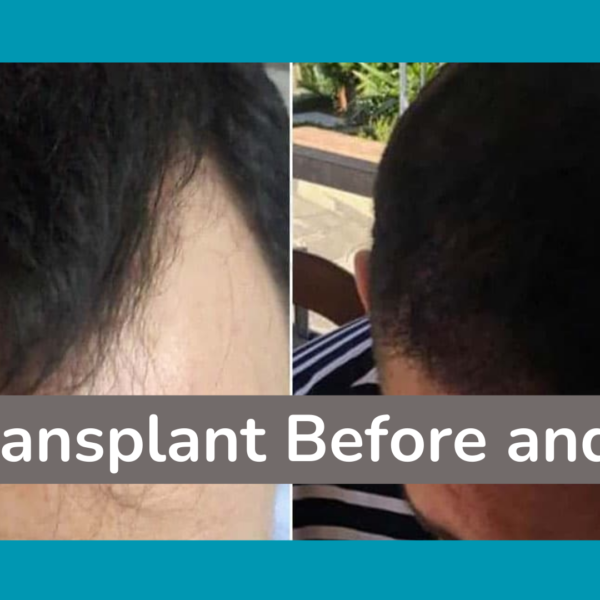 Hair Transplant Before and After