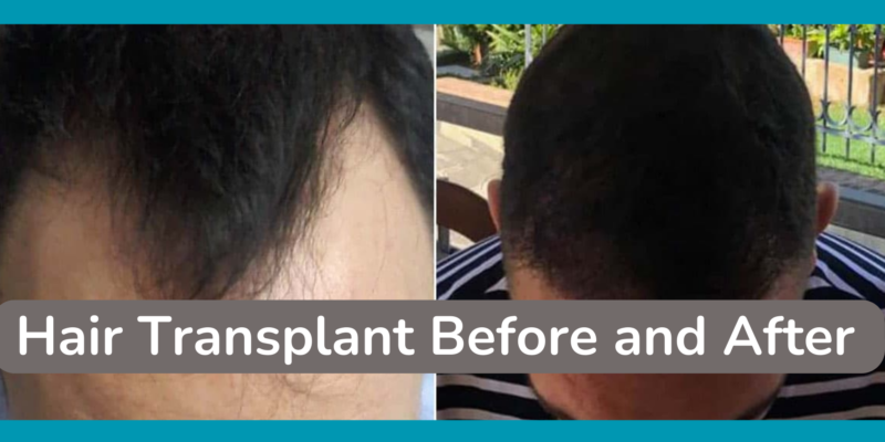 Hair Transplant Before and After