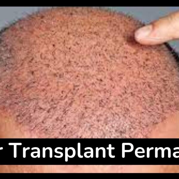 Is Hair Transplant Permanant ?