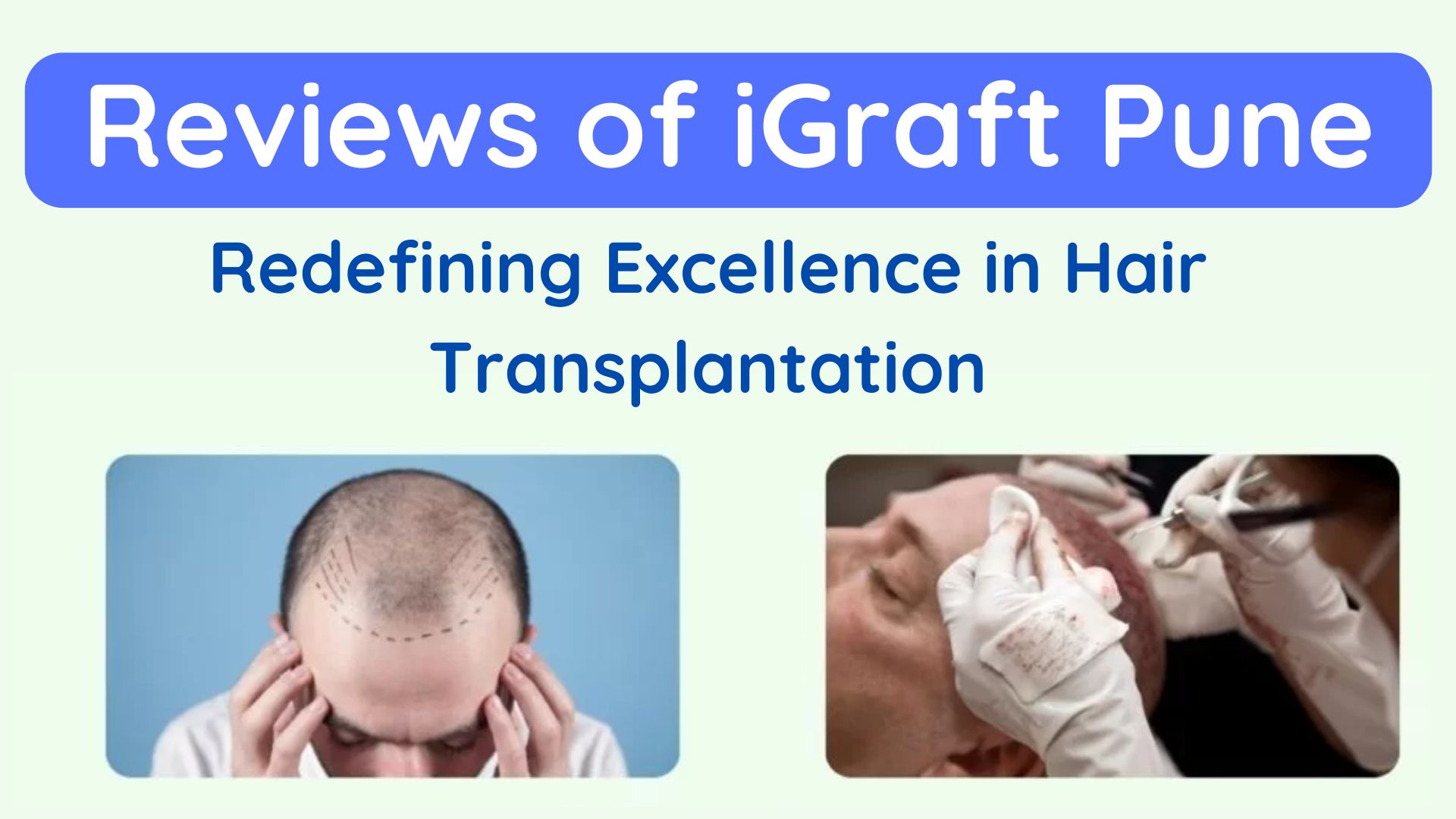 Redefining Excellence in Hair Transplantation