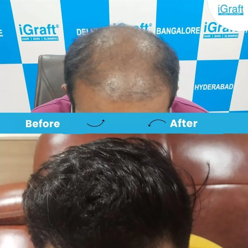 Igraft pune reviews