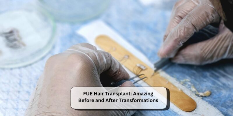 FUE Hair Transplant
