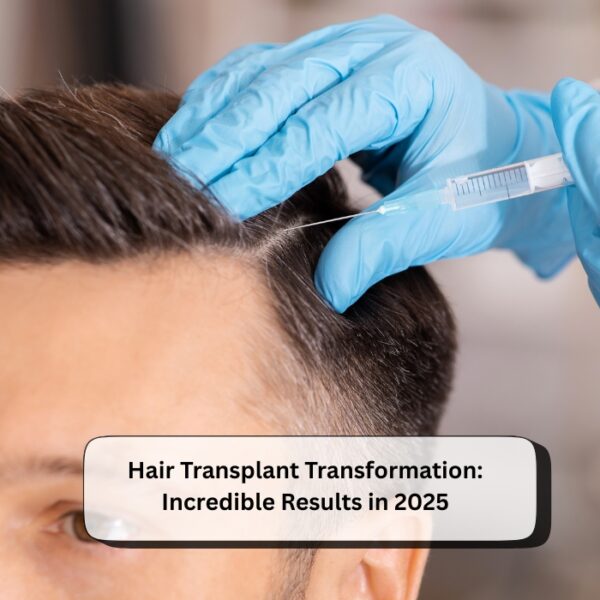 Hair Transplant Transformation