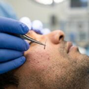 beard restoration