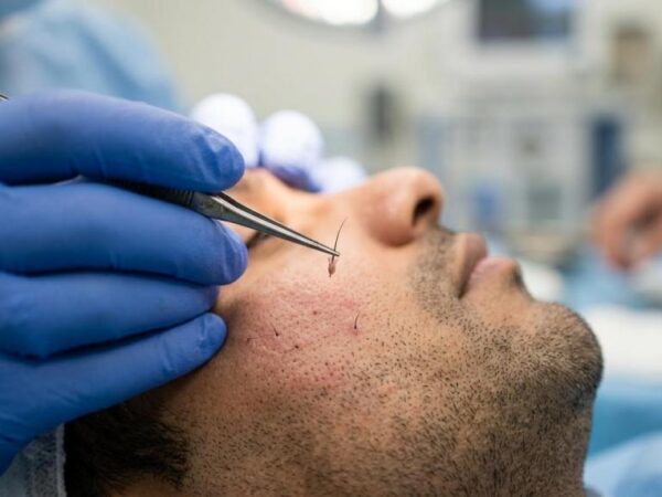 beard restoration