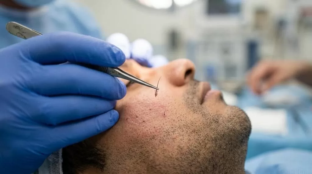 beard restoration