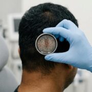 best hair transplant doctor in hyderabad