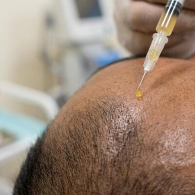 prp hair therapy