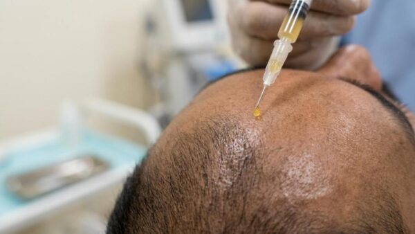 prp hair therapy