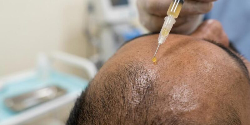 prp hair therapy