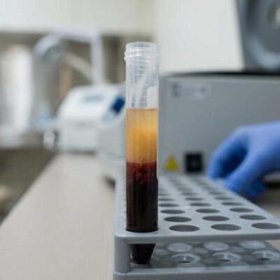 prp hair treatment