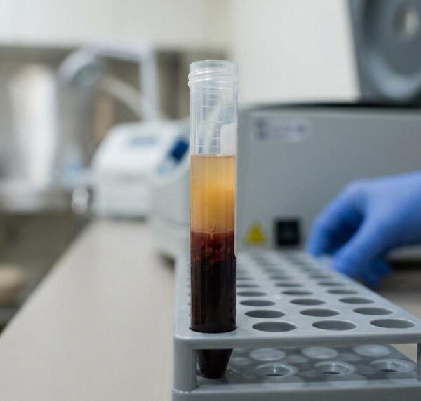 prp hair treatment