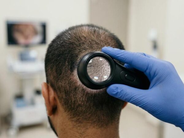 revision hair transplant
